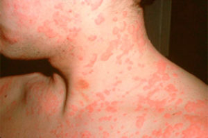 Як проявляється алергія на прополіс