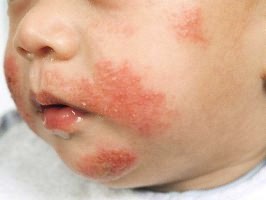 Алергія на мед у дітей