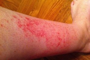 Алергія на віск: ознаки, методи лікування алергії