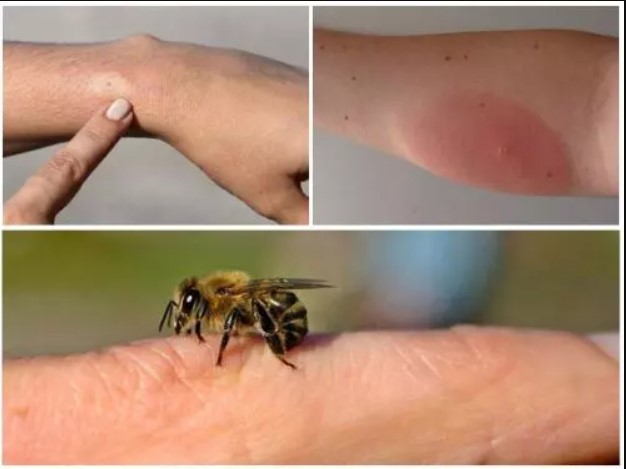 What to do if bitten by a bee